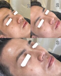 1.施術前2.シェービング後3.オゾン後