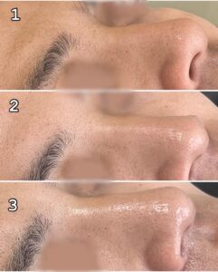 1.施術前2.シェービング後3.オゾン後